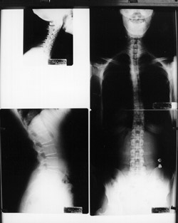 Chiropractic X-Rays